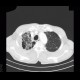 Bullous emphysema, lung tumour: CT - Computed tomography